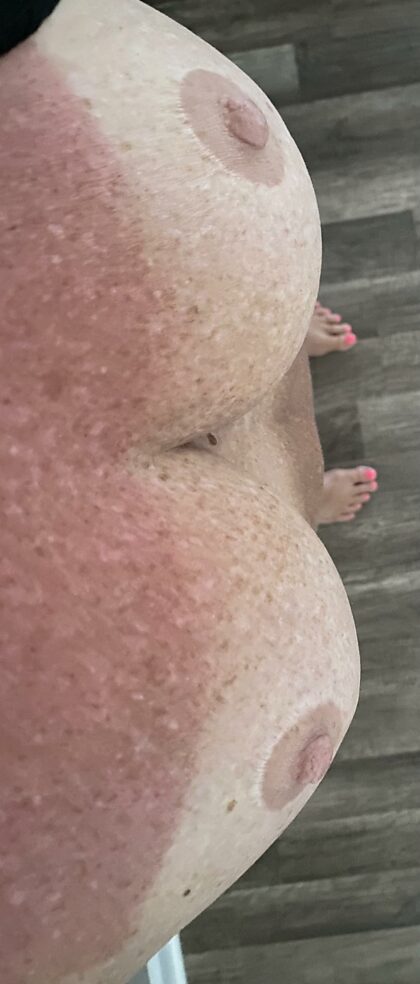Need a volunteer to put lotion on my sunburn.